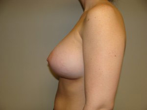 Breast Augmentation Before and After 306 | Grover Aesthetics