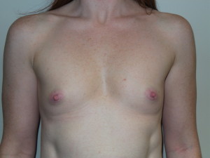 Breast Augmentation Before and After | Grover Aesthetics