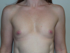 Breast Augmentation Before and After 202 | Sanjay Grover MD FACS