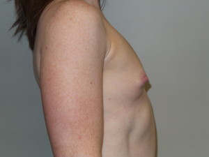 Breast Augmentation Before and After 307 | Grover Aesthetics