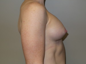 Breast Augmentation Before and After 307 | Grover Aesthetics