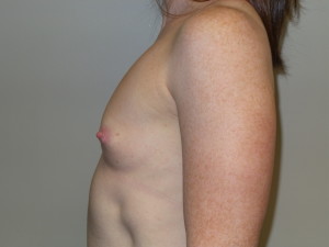 Breast Augmentation Before and After 307 | Grover Aesthetics
