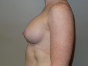 Breast Augmentation Before and After 307 | Grover Aesthetics