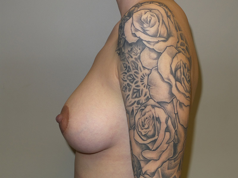 Breast Augmentation Before and After 308 | Grover Aesthetics