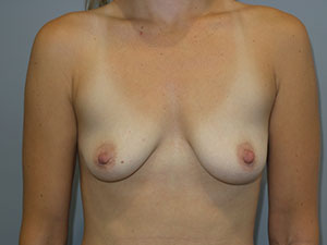 Breast Augmentation Before and After | Sanjay Grover MD FACS