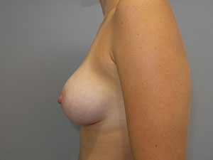 Breast Augmentation Before and After 309 | Grover Aesthetics