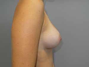 Breast Augmentation Before and After 309 | Grover Aesthetics