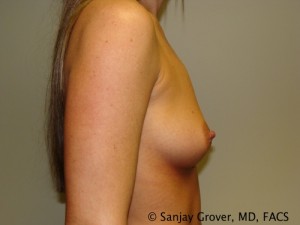 Breast Augmentation Before and After 31 | Grover Aesthetics
