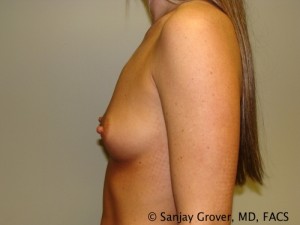 Breast Augmentation Before and After 31 | Sanjay Grover MD FACS