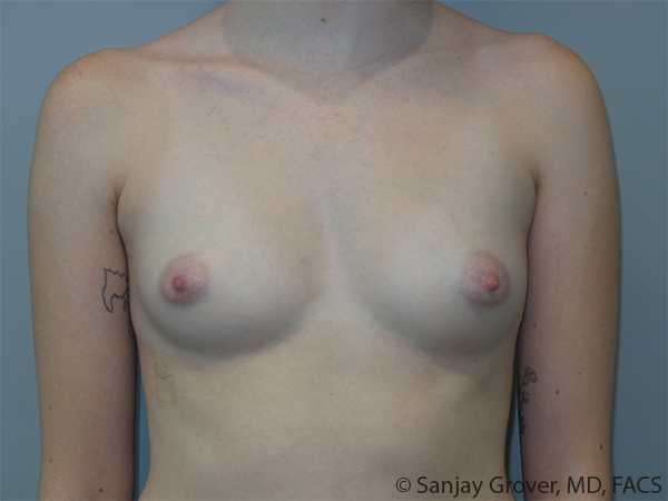Breast Augmentation Before and After | Grover Aesthetics