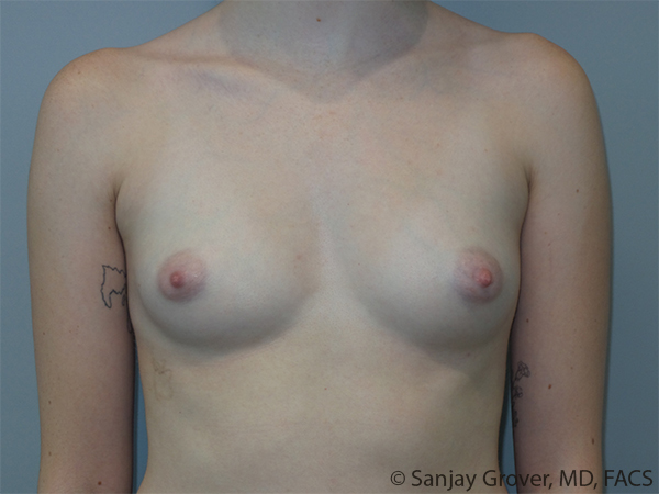 Breast Augmentation Before and After 152 | Sanjay Grover MD FACS