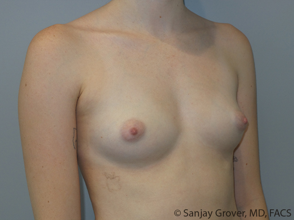 Breast Augmentation Before and After 310 | Sanjay Grover MD FACS