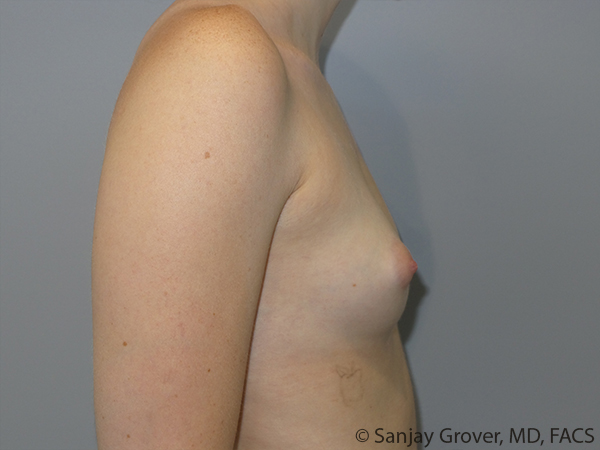 Breast Augmentation Before and After 310 | Grover Aesthetics