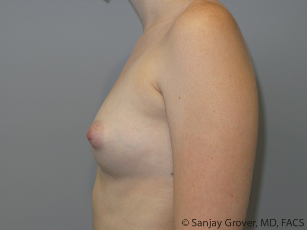 Breast Augmentation Before and After 310 | Grover Aesthetics