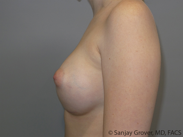 Breast Augmentation Before and After 310 | Grover Aesthetics