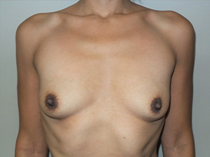 Breast Augmentation Before and After 313 | Sanjay Grover MD FACS