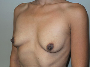 Breast Augmentation Before and After 313 | Grover Aesthetics