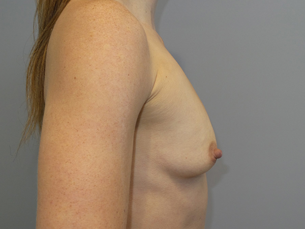 Breast Augmentation Before and After 313 | Sanjay Grover MD FACS
