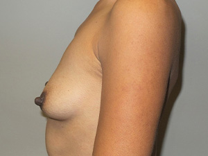 Breast Augmentation Before and After 313 | Grover Aesthetics