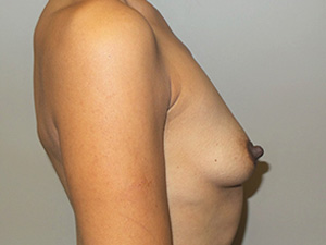 Breast Augmentation Before and After 313 | Grover Aesthetics