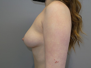 Breast Augmentation Before and After 315 | Grover Aesthetics