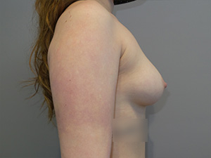 Breast Augmentation Before and After 315 | Grover Aesthetics
