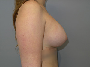 Breast Augmentation Before and After 315 | Grover Aesthetics