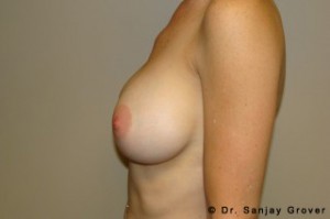 Breast Augmentation Before and After 316 | Grover Aesthetics