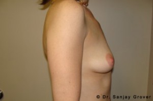 Breast Augmentation Before and After 316 | Grover Aesthetics
