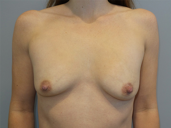 Breast Augmentation Before and After | Grover Aesthetics