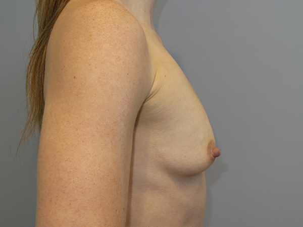Breast Augmentation Before and After 317 | Grover Aesthetics