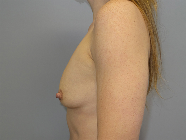 Breast Augmentation Before and After 317 | Grover Aesthetics