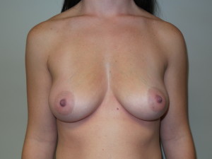 Breast Augmentation Before and After | Grover Aesthetics