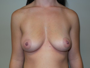 Breast Augmentation Before and After 300 | Sanjay Grover MD FACS