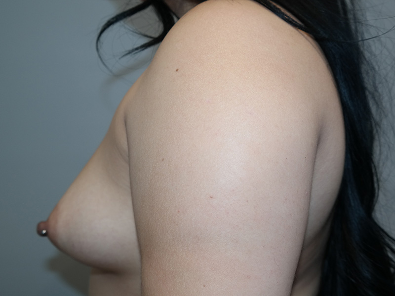 Breast Augmentation Before and After 321 | Grover Aesthetics