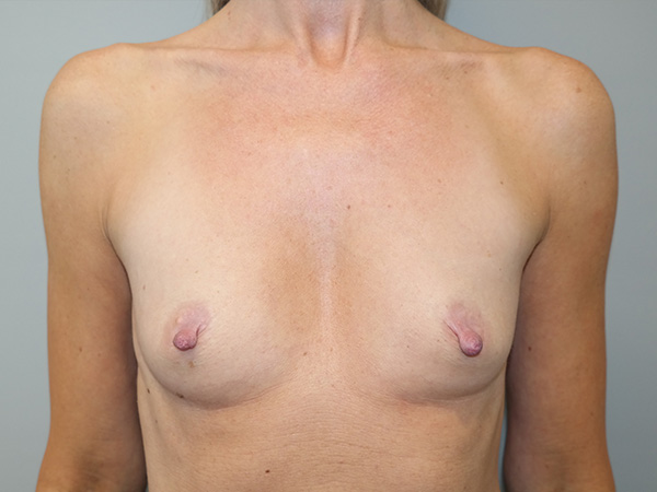Breast Augmentation Before and After | Grover Aesthetics