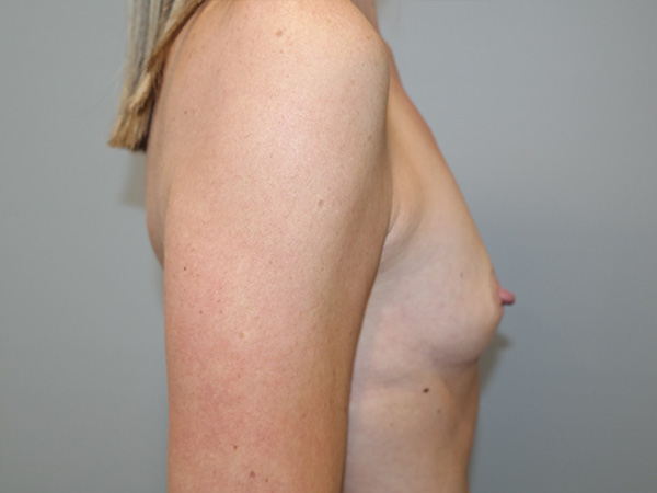 Breast Augmentation Before and After 322 | Grover Aesthetics