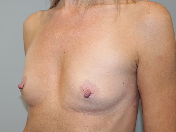 Breast Augmentation Before and After 322 | Grover Aesthetics