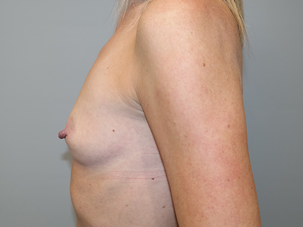 Breast Augmentation Before and After 322 | Grover Aesthetics
