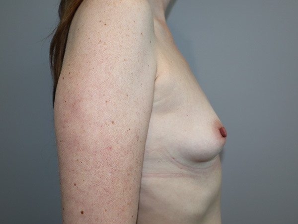 Breast Augmentation Before and After 323 | Grover Aesthetics