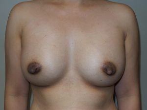 Breast Augmentation Before and After | Grover Aesthetics