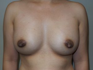 Breast Augmentation Before and After | Sanjay Grover MD FACS