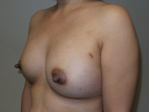 Breast Augmentation Before and After 33 | Grover Aesthetics