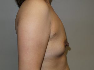 Breast Augmentation Before and After 33 | Grover Aesthetics