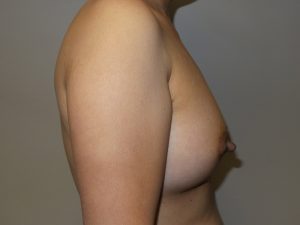 Breast Augmentation Before and After 33 | Grover Aesthetics
