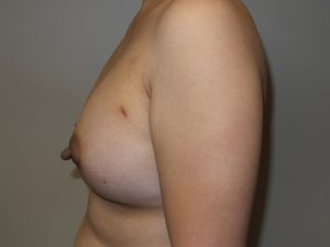 Breast Augmentation Before and After 33 | Grover Aesthetics