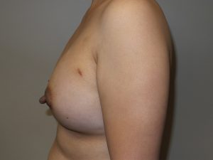 Breast Augmentation Before and After 33 | Sanjay Grover MD FACS