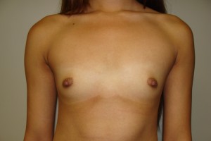 Breast Augmentation Before and After | Grover Aesthetics