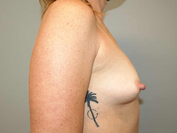 Breast Augmentation Before and After 36 | Grover Aesthetics