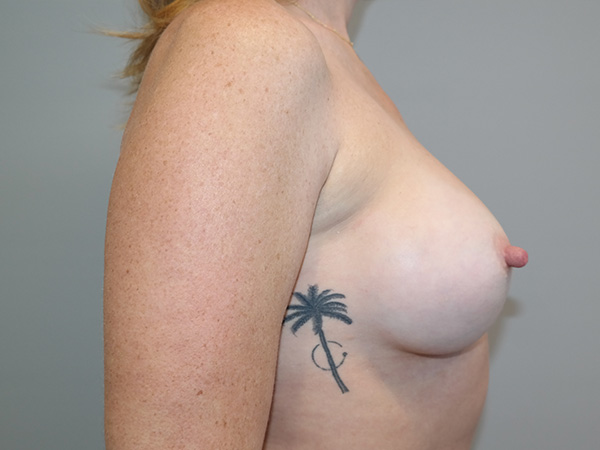 Breast Augmentation Before and After 36 | Grover Aesthetics